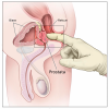 Rektal-digitale_Untersuchung.thumb.png.404028e1a88b0fffba1acea9f22139c7.png